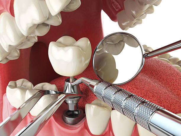 Best Emergency Wisdom Teeth Removal in Toulon, IL